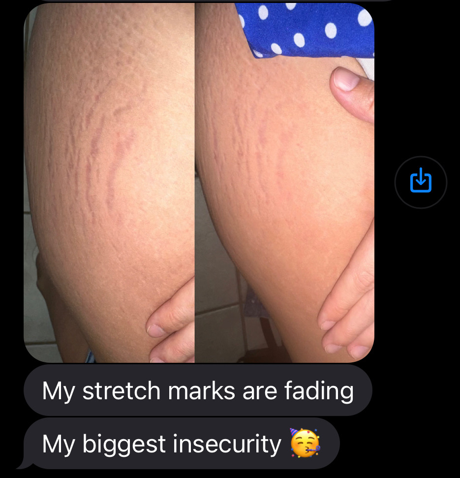 Woman showing stretch marks that have faded using Herbal Face Food products